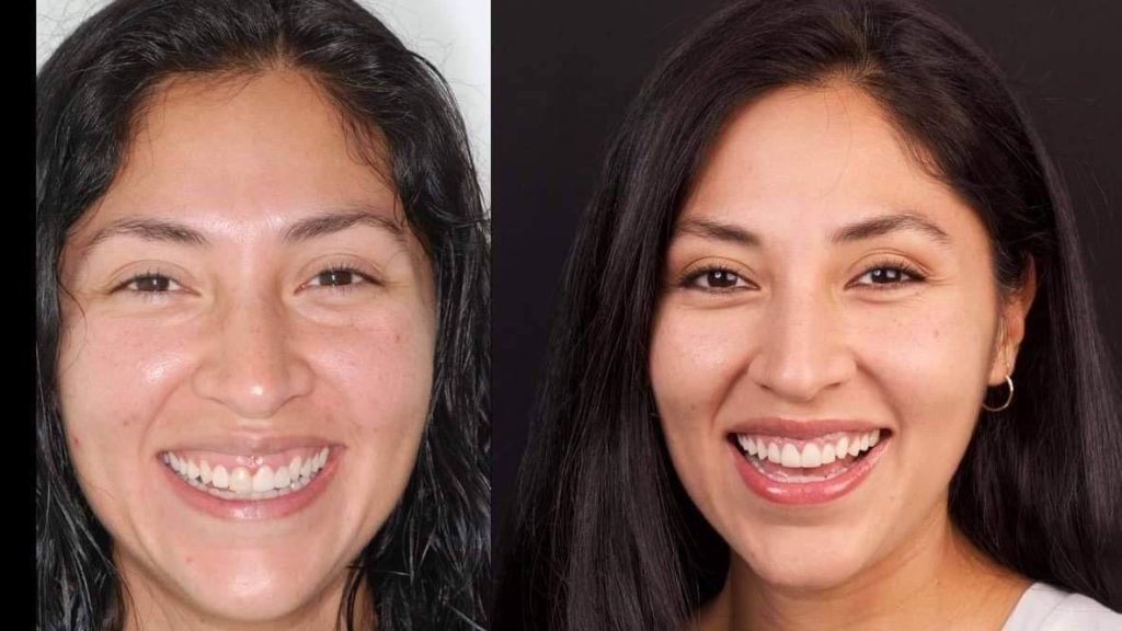Antes y despues carillas dentales en cuernavaca