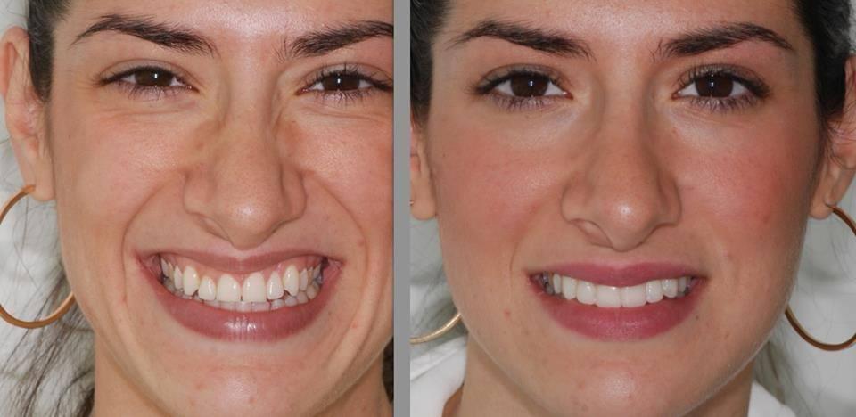 Antes y despues carillas dentales en cuernavaca